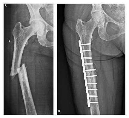 Femur Bone Fracture Surgery