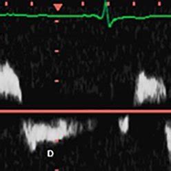 Spectral Doppler waveforms demonstrate laminar (A), disturbed (B), and... | Download Scientific ...