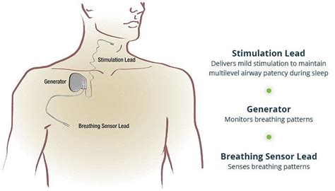 inspire sleep apnea doctors near me - Vita Samuels