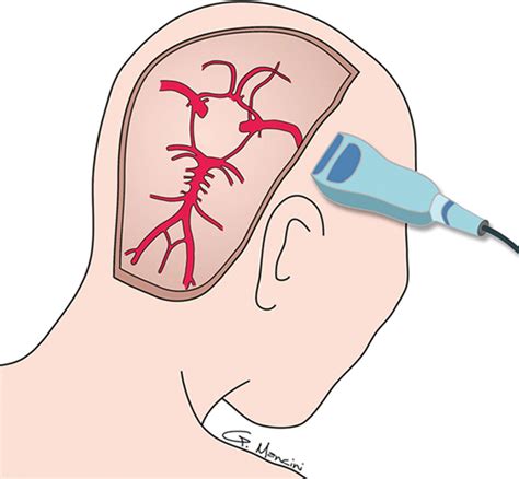 Advances in Transcranial Doppler US: Imaging Ahead | RadioGraphics