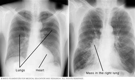 Radiografía | Beacon Health System