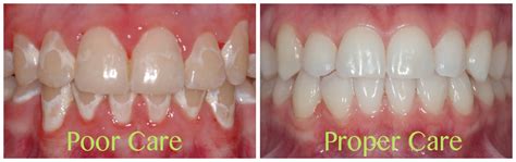 Do Orthodontic Braces Cause White Spots on Teeth? | Dr. Kyle Fagala