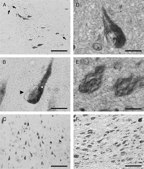 Neurofibrillary tangles (NFTs) immunoreactive to Tau-C3 and MN423... | Download Scientific Diagram