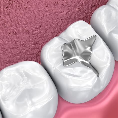 Comprehensive Shield: The Wider Benefits of Fissure Sealants Beyond Cavities | by Aelite Dental ...