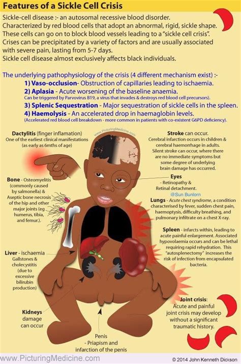 Sickle Cell Symptoms