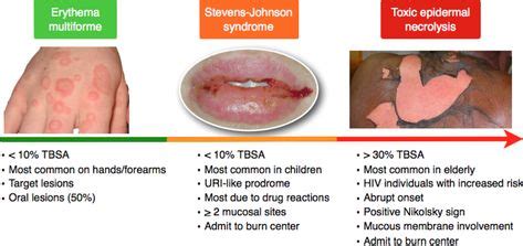 Erythema Multiforme, Steven Johnson syndrome, Toxic Epidermal ...