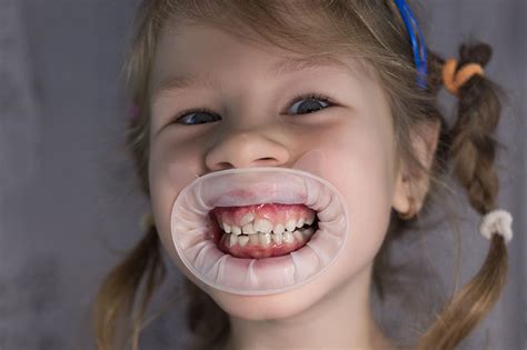 What Shark Teeth Means for a Child's Oral Health | Kenmore, WA ...