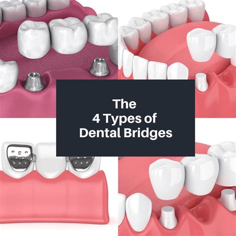 The 4 Types of Dental Bridges