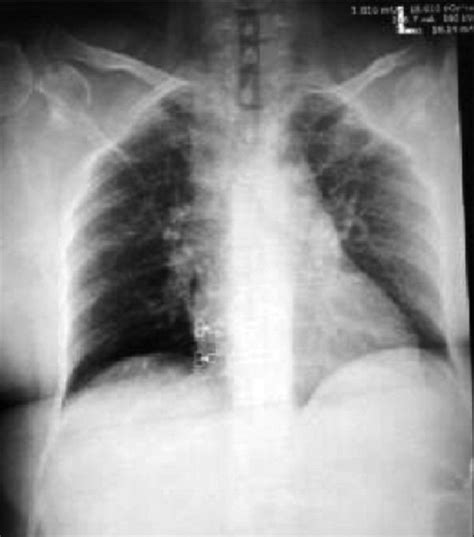 Chest x-ray showing upper respiratory tract infection and lung infiltrates. | Download ...