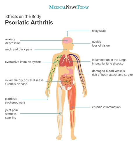 8 effects of psoriatic arthritis on the body Yoga For Arthritis, Arthritis Hands, Rheumatoid ...