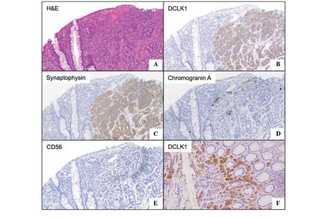 High expression of the putative cancer stem cell marker, DCLK1, in rectal neuroendocrine tumors