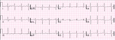 Dr. Smith's ECG Blog: Chronic Right Ventricular Hypertrophy, or Acute Right Heart Strain? The ...