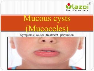 Mucous cysts (Mucoceles): Symptoms, causes, treatment and preventions ...