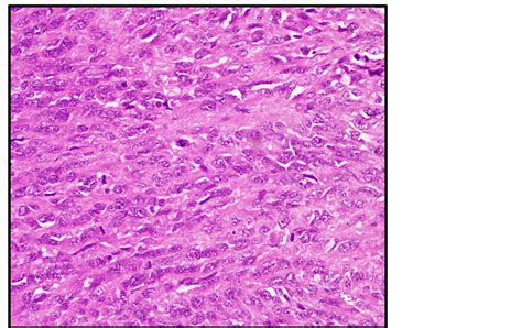 Spindle Cell Carcinoma of the Maxilla: A Case Report of Rare Entity