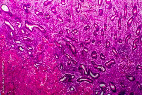 Endometrial hyperplasia, light micrograph Stock Photo | Adobe Stock