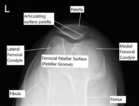 KneeCap Maltracking and Management - Complete Orthopedics