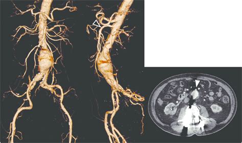 Pre-procedural images: CT images show infrarenal AAA (5.0 cm). There is... | Download Scientific ...