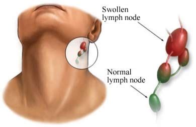 Herbal Remedies for Swollen Lymph Nodes, Ayurvedic Treatment - Causes ...