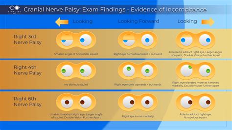 Causes for Strabismus: Cranial Nerve Palsy - PinpointEyes