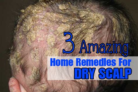 3 Amazing Home Remedies For Dry Scalp | HealthRelieve.com