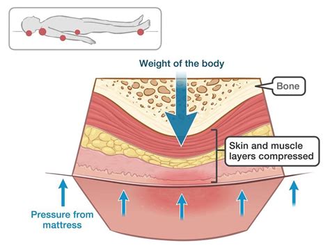 Clinical Focus – Pressure Injury Prevention & Care – Woundcare.ie