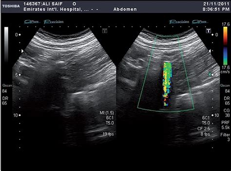 SciELO - Brasil - Value of color doppler ultrasound, kub and urinalysis ...