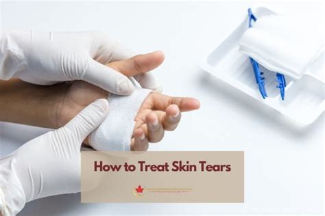 How to Treat Skin Tears