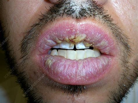 Actinic cheilitis - Stock Image - C057/0594 - Science Photo Library