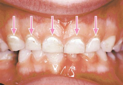 Tooth Decay In Baby Teeth Treatment - TeethWalls