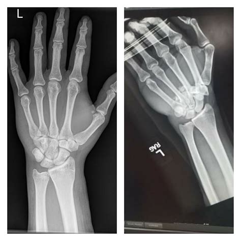 What a normal hand x-ray looks like (left) and what I managed to do to my hand(right). Local ...