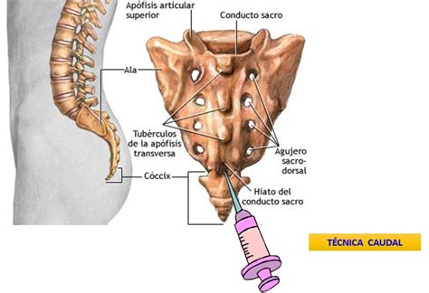 Técnica epidural caudal | Dolopedia