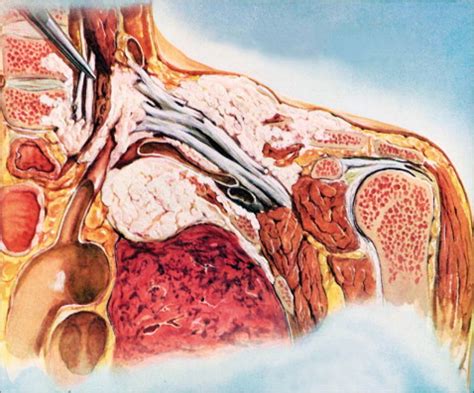 Pancoast Tumor: Symptoms, Causes, Diagnosis, Treatment