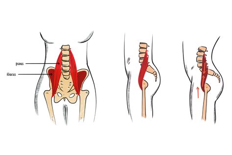 Lateral Pelvic Tilt Correction Exercises