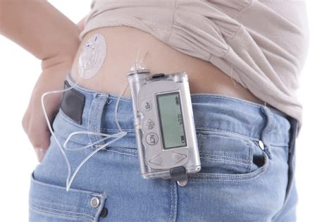 Study: Insulin Pumps Decrease Quality of Life and Increase A1c in CGM Users – Diabetes Daily