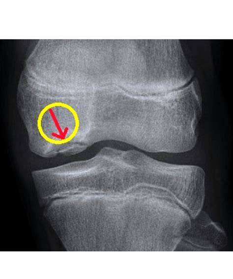 Osteochondritis Dissecans of the Knee Joint — OrthopaedicPrinciples.com