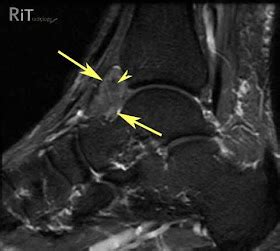 RiT radiology: Pigmented Villonodular Synovitis (PVNS) of the Ankle