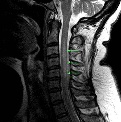 Subacute Combined Degeneration - Stepwards