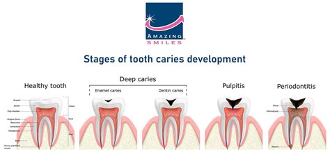 Tooth Cavity Stages