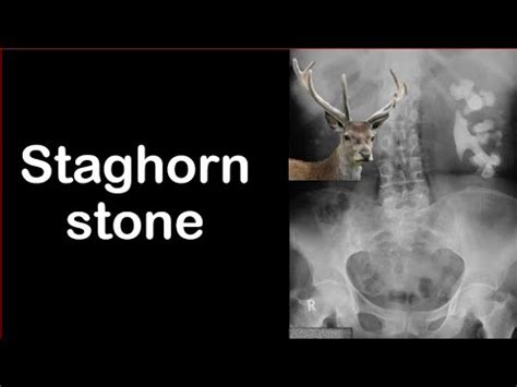 Staghorn stone🦌 - YouTube