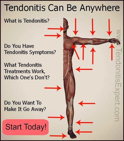 17 Best images about Tendonitis Info. on Pinterest