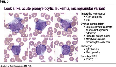 Close-up on abnormal monocyte morphology in peripheral blood smears - Page 2 of 2 - CAP TODAY