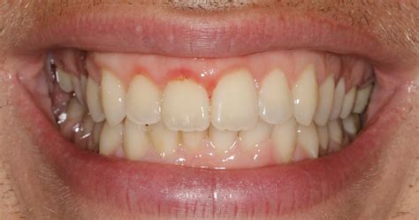 Soft Tissue Gum Graft | Before & After | Periodontist NYC