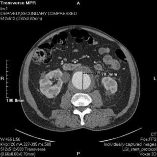 CT aortogram demonstrating a 5.6 cm anteroposterior diameter AAA ...