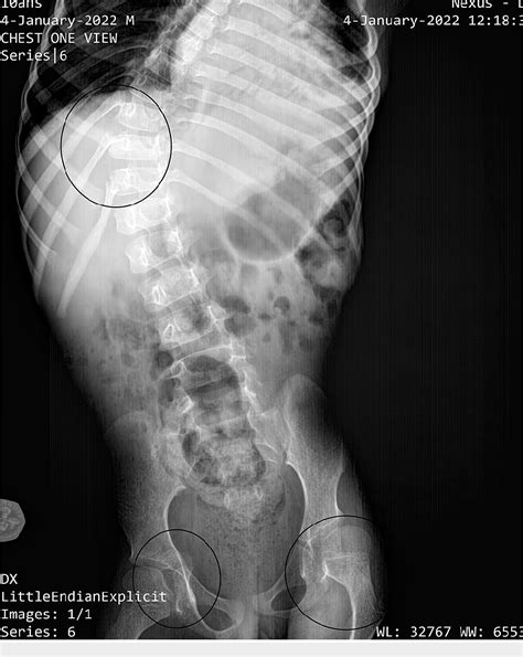 Figure 2 from Osteogenesis Imperfecta Type 3 in a 10-Year-Old Child ...