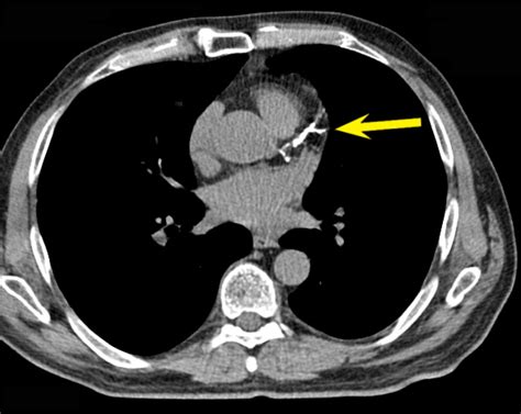 85% Coronary Artery Blockage found with NO SYMPTOMS – THE Q INSTITUTE