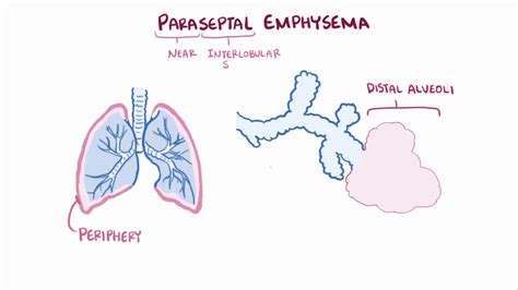 Emphysema chronic obstructive pulmonary disease centriacinar, panacinar, paraseptal - YouTube