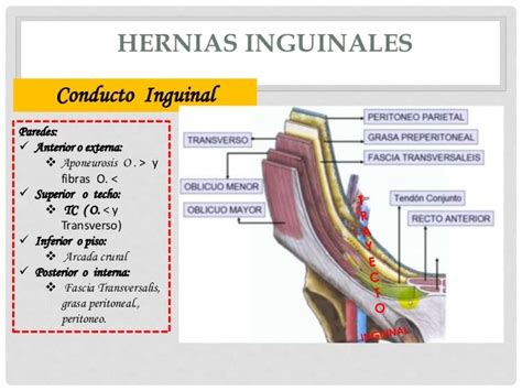 Femoral Nerve Paralysis Following Open Inguinal Hernia Repair