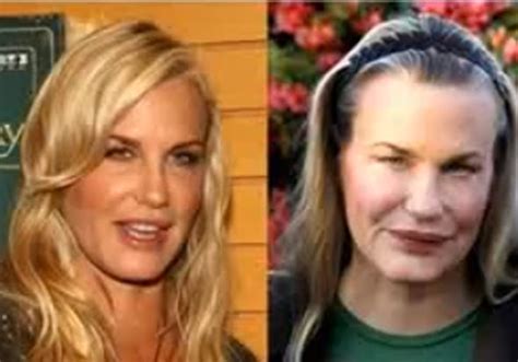 17 Celebrity Before-And-After Plastic Surgery Disasters | Business Insider