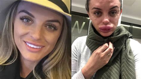 Woman's Lips Grow Massively After Bad Lip Injections - Before and After - YouTube