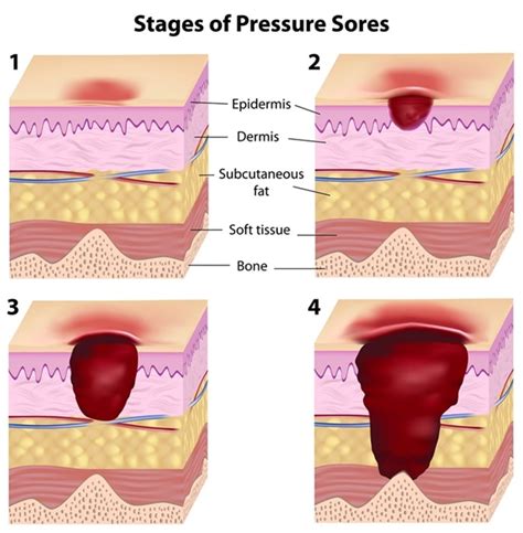 Pressure Ulcer